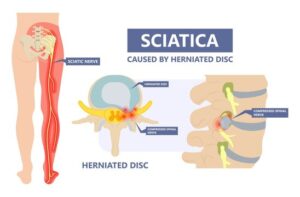 diagram of sciatica and the areas it can cause discomfort
